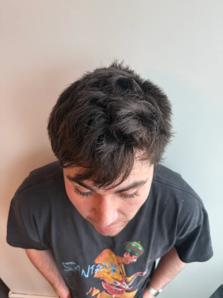 Después de seis meses de tratamiento de Fede S., 27